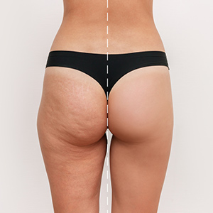Cellulite Reduction at NY Medical Weight Loss Near Me in Garden City, NY