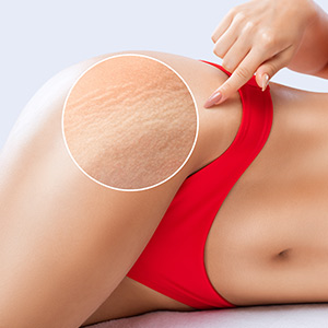 Stretch Mark Removal at NY Medical Weight Loss Near Me in Garden City, NY