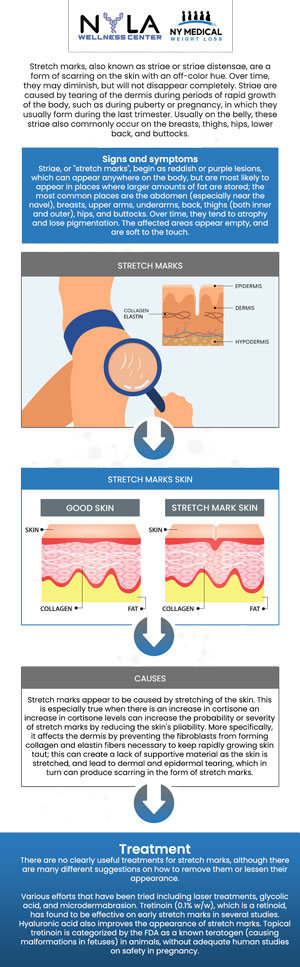 Stretch mark removal treatments are used to diminish the visibility of stretch marks, which commonly occur due to rapid skin stretching from reasons such as pregnancy, weight changes, or growth spurts. At NY Medical Weight Loss, our professional team is dedicated to supporting every step of their weight loss journey, including managing and preventing stretch marks. For more information, contact us or schedule an appointment online. We are conveniently located at 65 Hilton Ave #250, Garden City, NY 11530. Stretch mark removal treatments are used to diminish the visibility of stretch marks, which commonly occur due to rapid skin stretching from reasons such as pregnancy, weight changes, or growth spurts. At NY Medical Weight Loss, our professional team is dedicated to supporting every step of their weight loss journey, including managing and preventing stretch marks. For more information, contact us or schedule an appointment online. We are conveniently located at 65 Hilton Ave #250, Garden City, NY 11530.