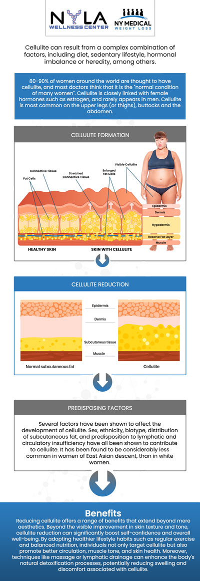 Cellulite reduction treatment is a non-invasive procedure aimed at smoothing and toning the skin while minimizing the appearance of cellulite. By targeting underlying fat deposits and enhancing circulation, these treatments help break down fat cells, tighten the skin, and improve overall texture. At NY Medical Weight Loss, our professionals are committed to helping you achieve your desired outcomes through tailored treatment plans and expert guidance. For more information, contact us or schedule an appointment online. We are conveniently located at 65 Hilton Ave #250, Garden City, NY 11530. Cellulite reduction treatment is a non-invasive procedure aimed at smoothing and toning the skin while minimizing the appearance of cellulite. By targeting underlying fat deposits and enhancing circulation, these treatments help break down fat cells, tighten the skin, and improve overall texture. At NY Medical Weight Loss, our professionals are committed to helping you achieve your desired outcomes through tailored treatment plans and expert guidance. For more information, contact us or schedule an appointment online. We are conveniently located at 65 Hilton Ave #250, Garden City, NY 11530.