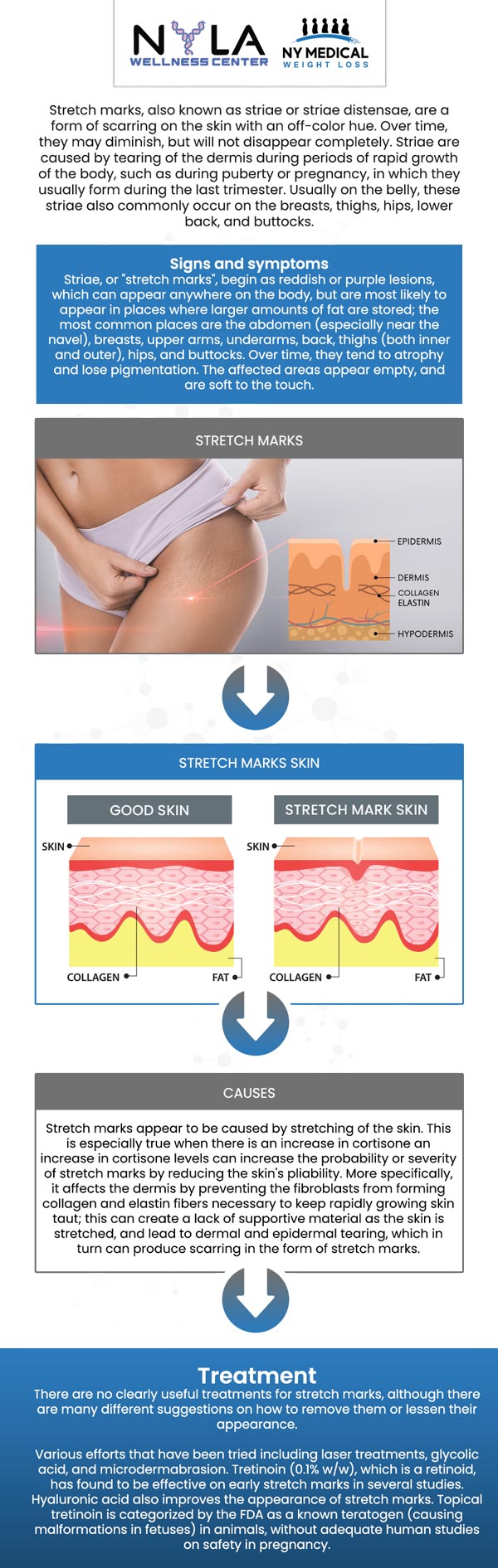 Stretch mark removal treatments are used to diminish the visibility of stretch marks, which commonly occur due to rapid skin stretching from reasons such as pregnancy, weight changes, or growth spurts. At NY Medical Weight Loss, our professional team is dedicated to supporting every step of their weight loss journey, including managing and preventing stretch marks. For more information, contact us or schedule an appointment online. We are conveniently located at 65 Hilton Ave #250, Garden City, NY 11530.