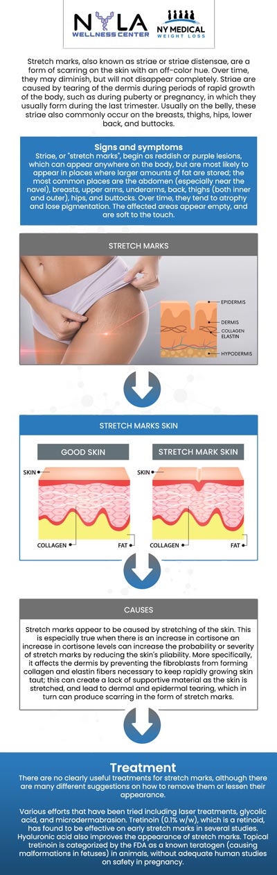Stretch mark removal treatments are used to diminish the visibility of stretch marks, which commonly occur due to rapid skin stretching from reasons such as pregnancy, weight changes, or growth spurts. At NY Medical Weight Loss, our professional team is dedicated to supporting every step of their weight loss journey, including managing and preventing stretch marks. For more information, contact us or schedule an appointment online. We are conveniently located at 65 Hilton Ave #250, Garden City, NY 11530.